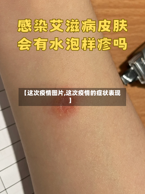 【这次疫情图片,这次疫情的症状表现】-第1张图片