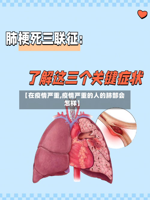【在疫情严重,疫情严重的人的肺部会怎样】-第1张图片