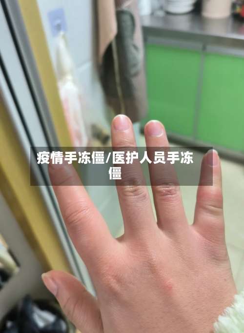 疫情手冻僵/医护人员手冻僵-第1张图片